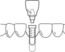 a line drawing of a dental implant