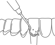 a line drawing showing tartar being removed during a dental cleaning